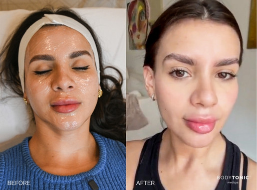 CO2 before and after treatment at BodyTonic medspa in Cleveland