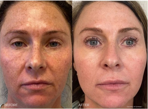 Coolpeel treatment in Cleveland before and after. Medspa in Cleveland