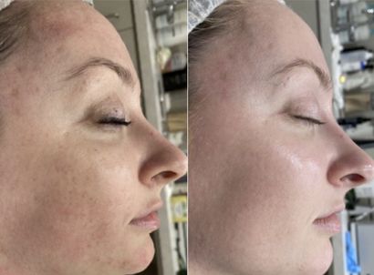 skin rejuvenation with BBL Photofacial