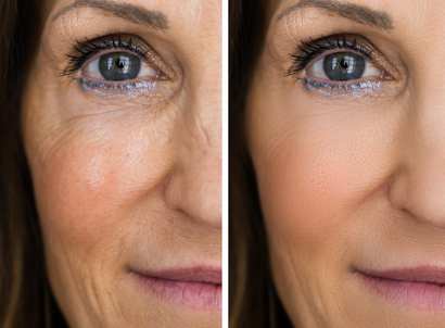 Before and after having a skin rejuvenation treatment called Thread lift on the left side of a woman's face