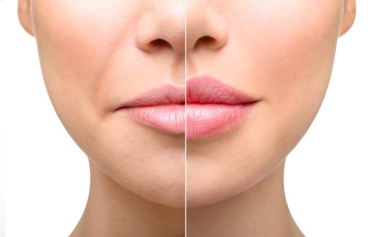 Injectable treatment before and after having a derma filler done in the lips