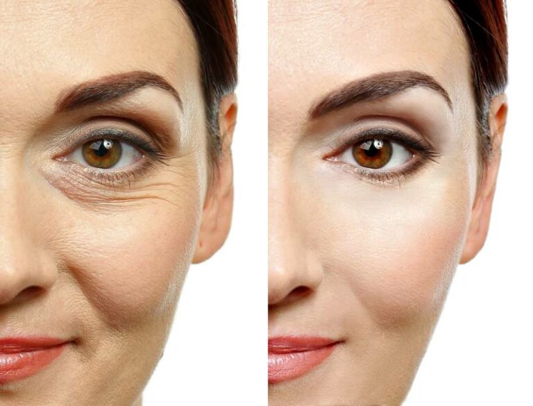 Injectable treatment before and after showing smooth skin around the eye