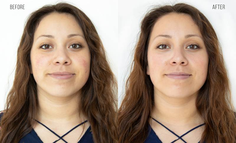 Medical facial - hydrafacial before and after
