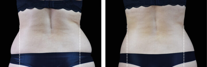 Before and after photos of a model showing the effects of Emsculpt body treatment on the lateral-abdomen