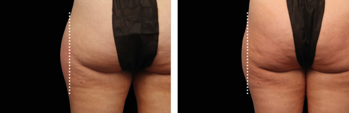 before and after photos of a model showing the effects of Emsculpt body treatment on the outer thighs