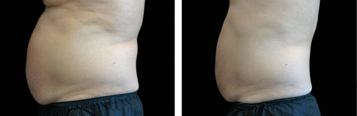 before and after photos of a male model showing the effects of Emsculpt body treatment on the abdomen