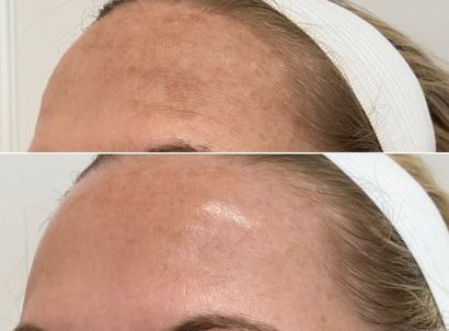 Medical facial- micro-needling performed on the forehead - befor and after