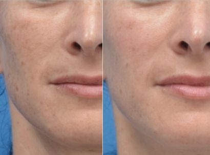 Skin rejuvenation treatment called skin resurfacing that shows before and after of the left side of a woman's skin