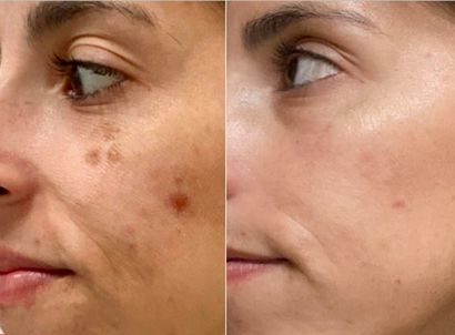 IPL and BBL photo-facial treatment done on a woman's cheek that reduces dark marks