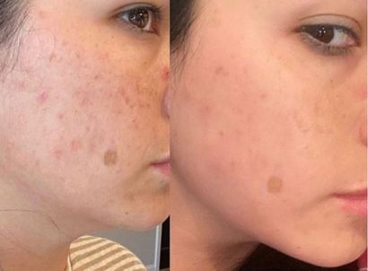 medical facial before and after - LED treatment in the cheeks