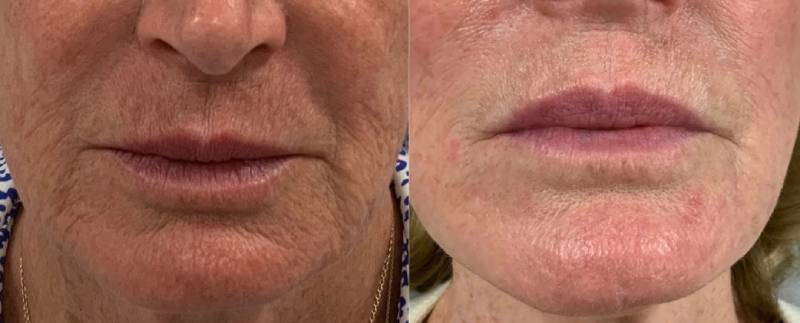 Before and after having a skin rejuvenation treatment called RF micro-needling treatment