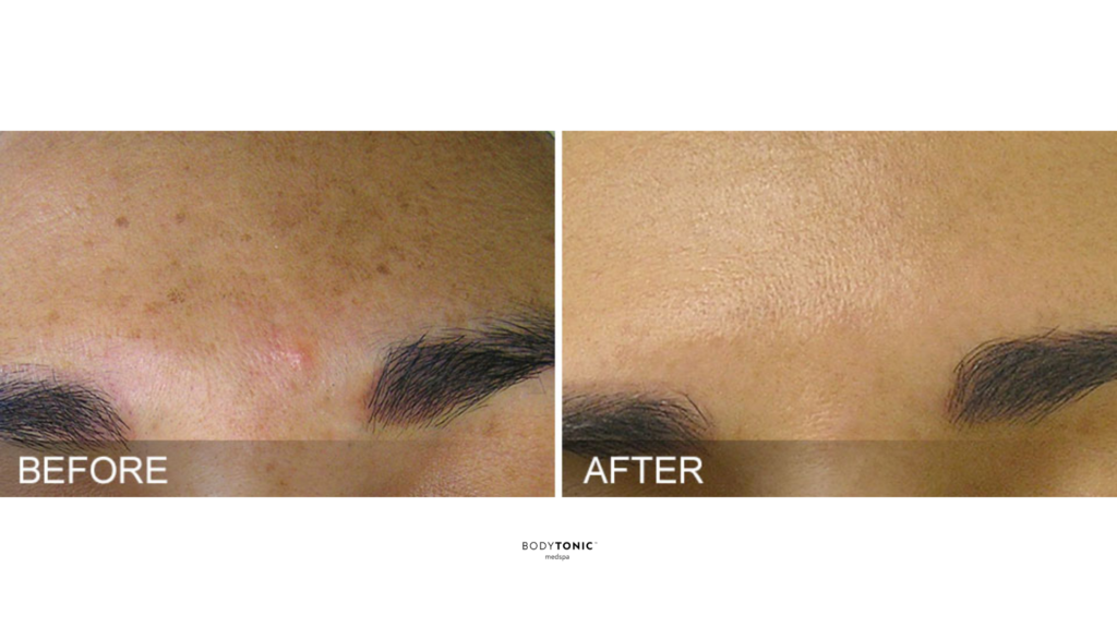 Before and after images showing the effects of a hydrafacial treatment on the forehead