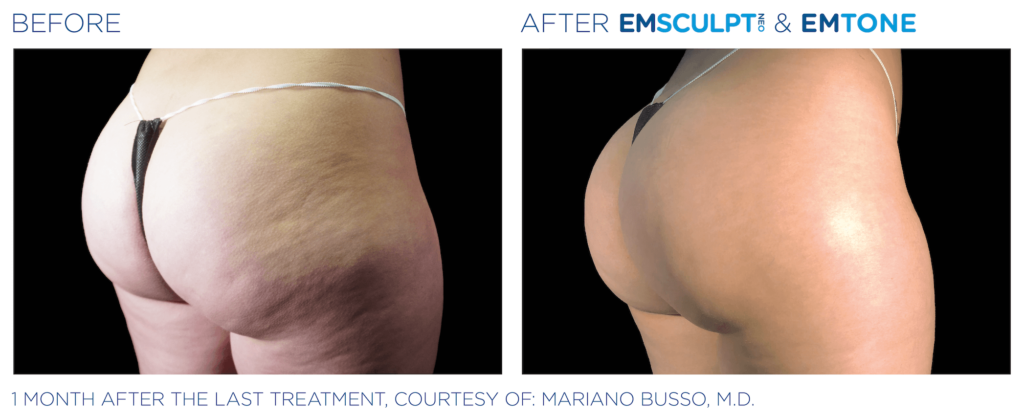 Emsculpt Neo before and after glutes - BodyTonic, Cleveland