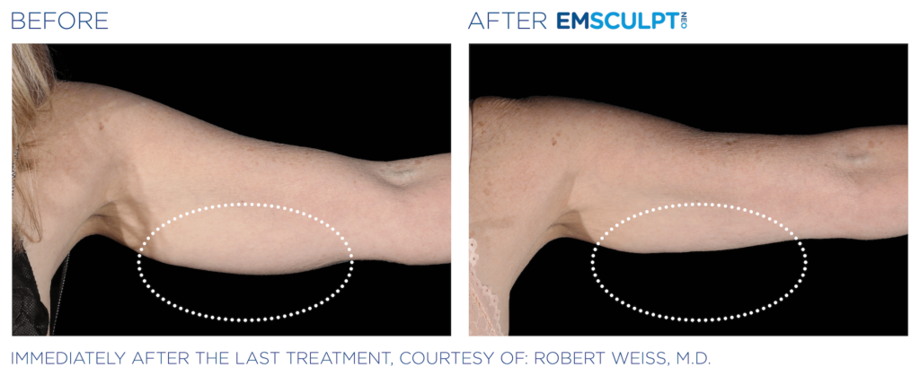Emsculpt Neo before and after arms - BodyTonic, Cleveland