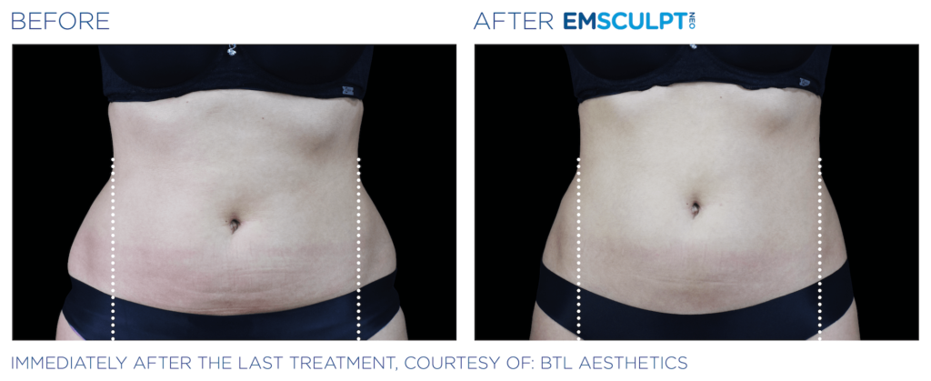 Emsculpt Neo before and after side handles - BodyTonic, Cleveland