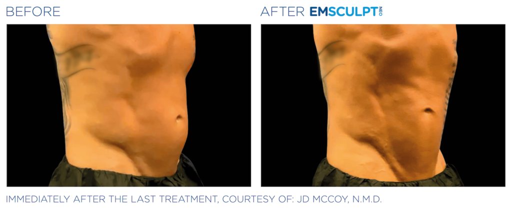 Emsculpt Neo before and after abdomen- BodyTonic, Cleveland