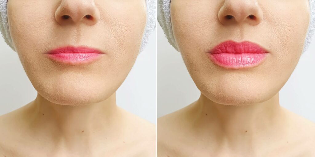 Natural lip fillers to augment and enhance