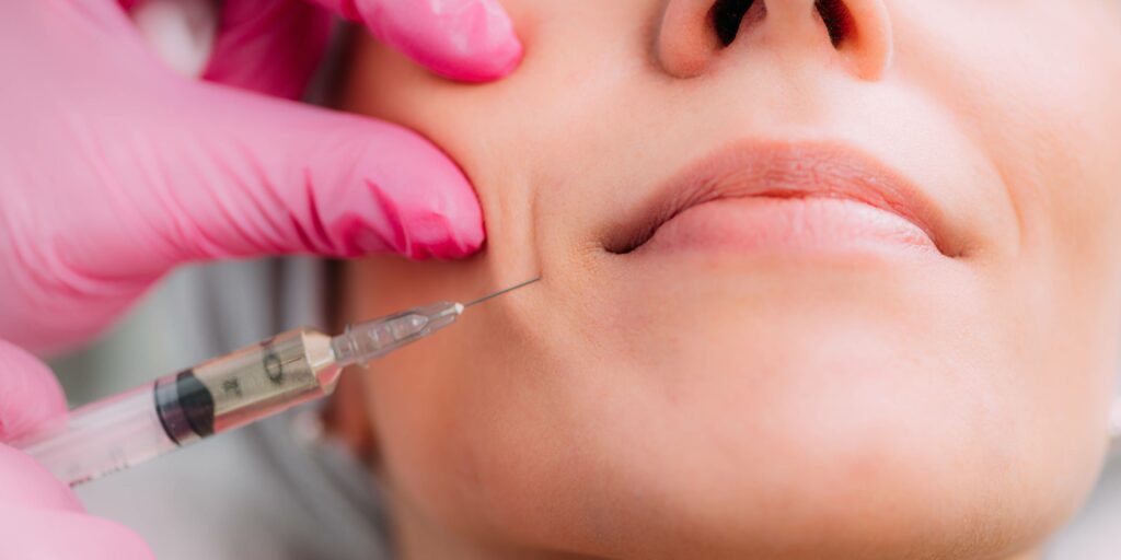 Fill out wrinkles and lines around the mouth and nose