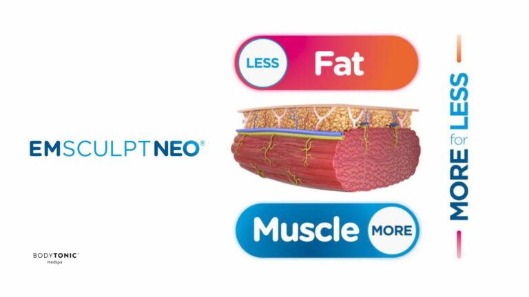 Emsculpt neo treatment at Bodytonic medspas