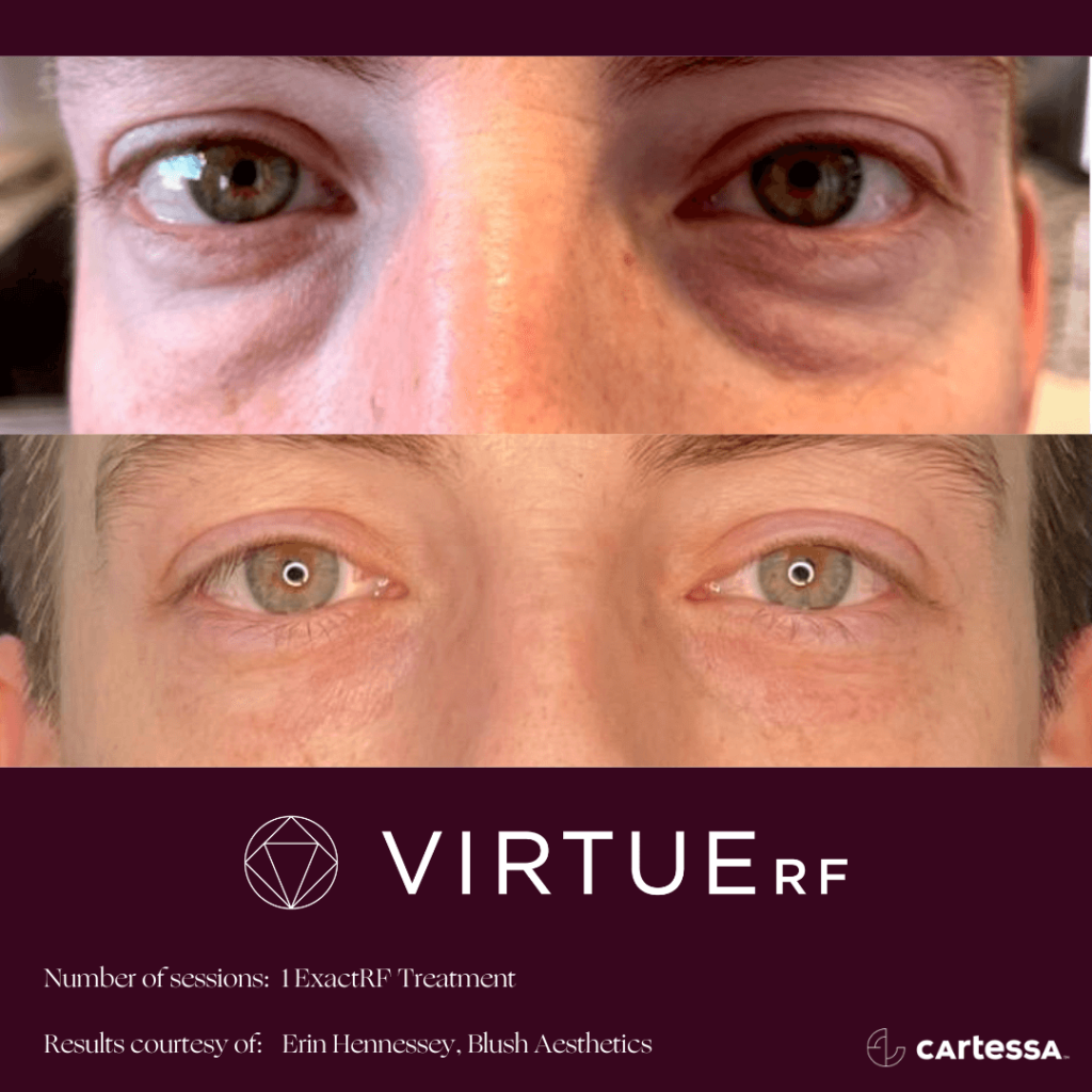 Virtue RF micro needling before and after