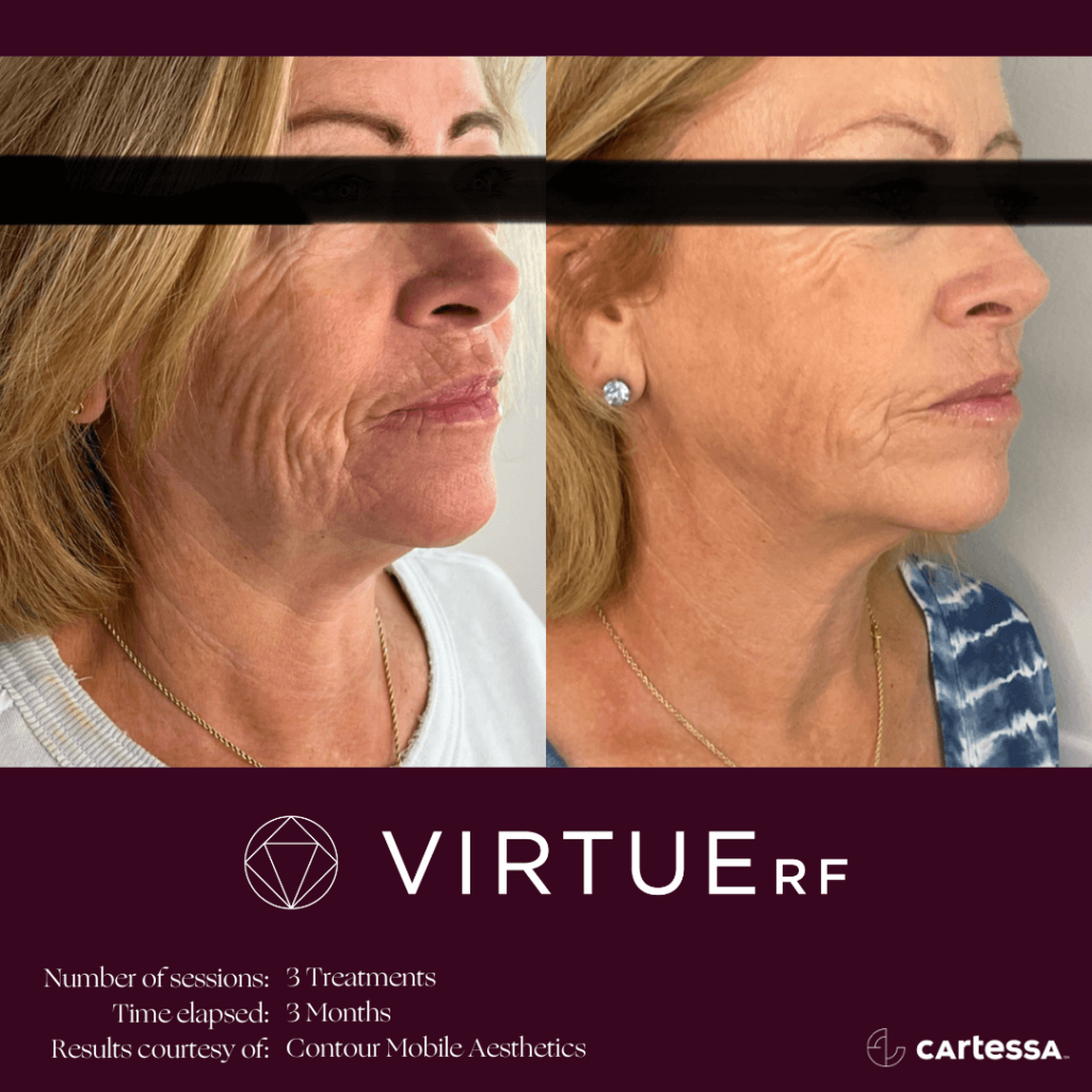 Virtue RF micro needling before and after - face
