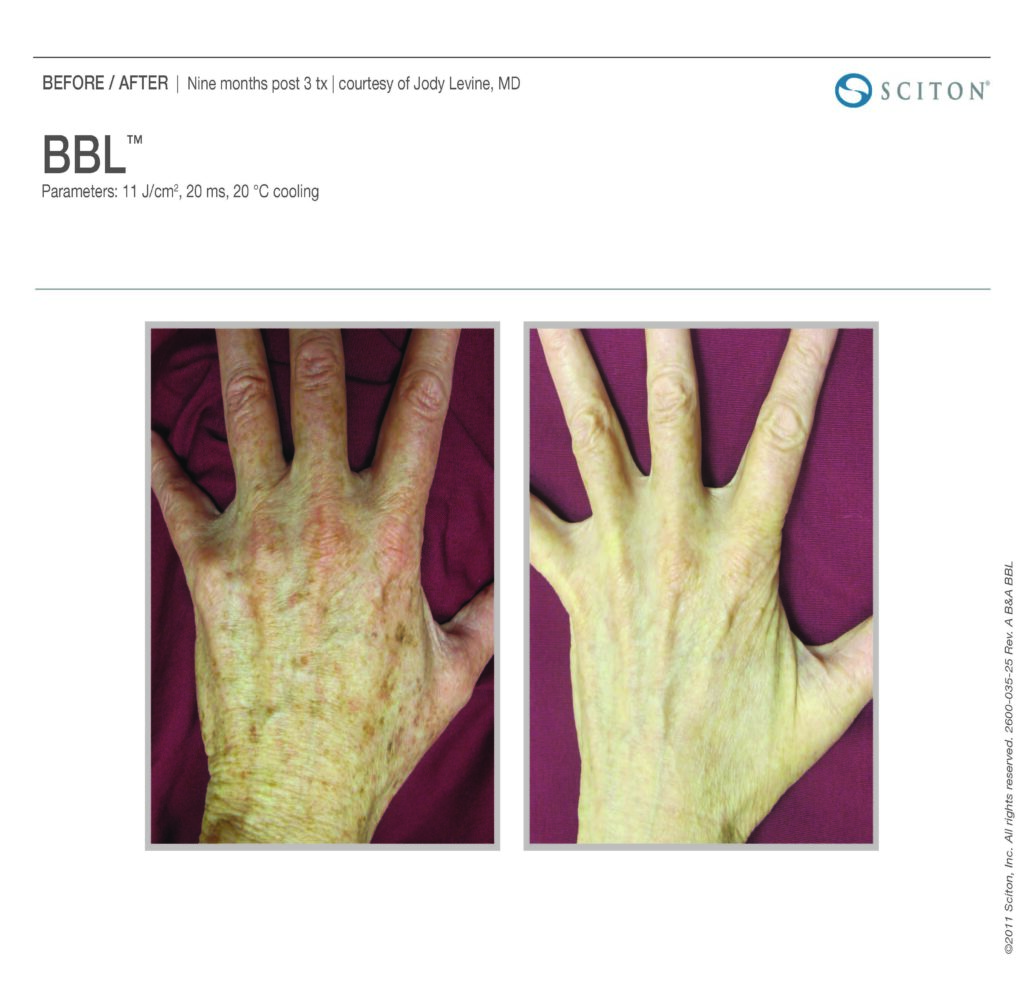 Sciton BBL Hero 9 months post 3 treatments