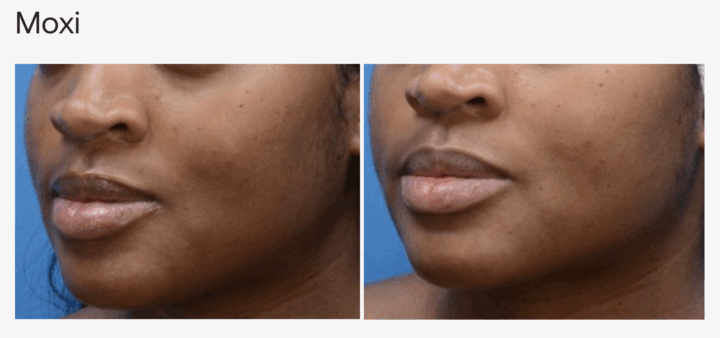 Moxi sciton - before and after