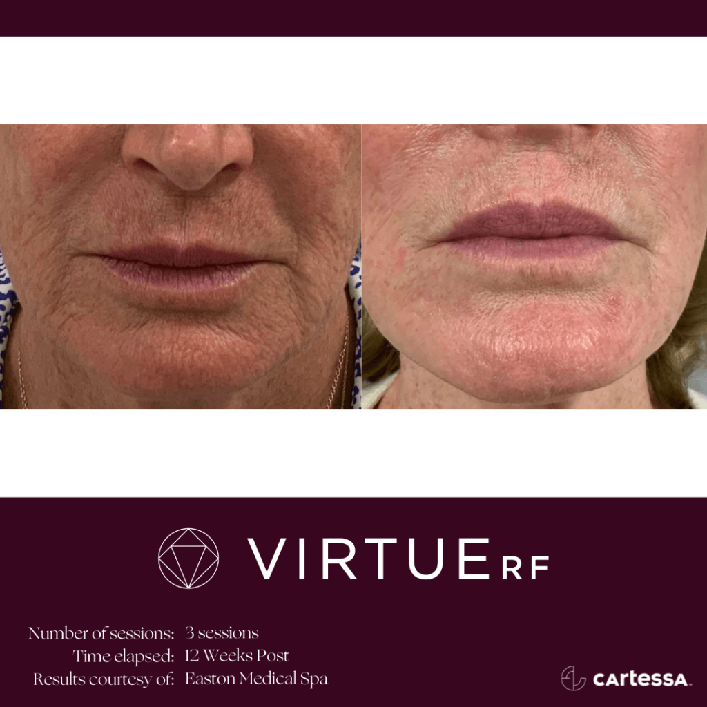 Virtue RF micro needling before and after