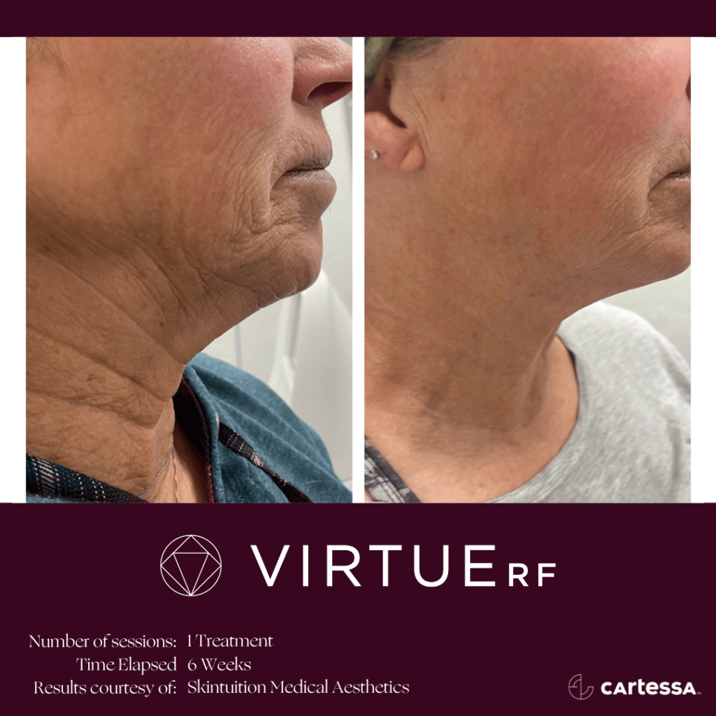 Virtue RF micro needling before and after - neck