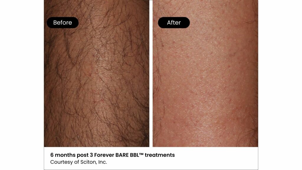 A pair of images showing the before-and-after results of laser hair removal on men's leg. The "before" image depicts hair growth in the leg, while the "after" image shows a significant reduction in hair growth six months after three laser hair removal sessions.