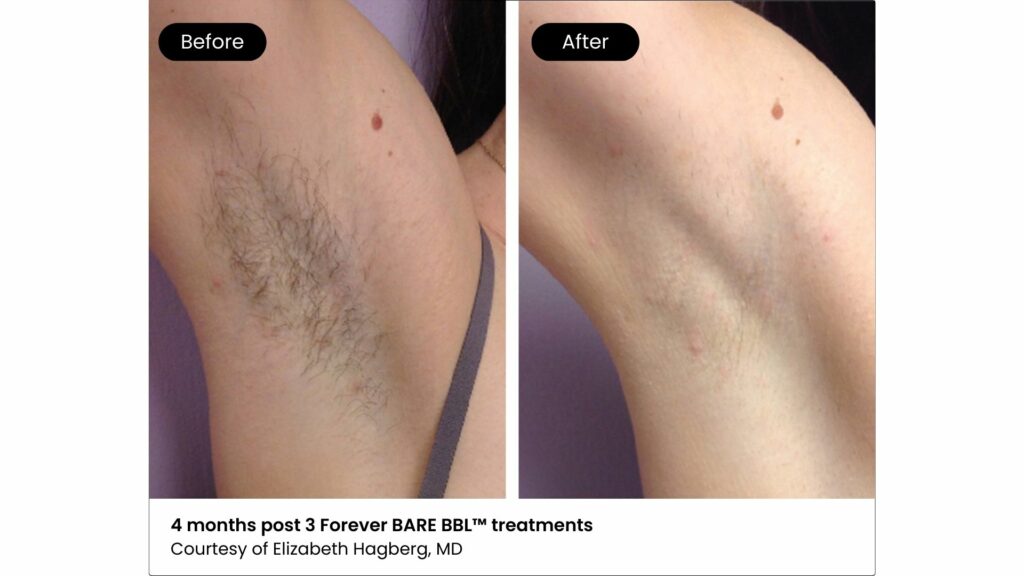 A pair of images showing the before-and-after results of laser hair removal on an armpit. The "before" image depicts hair growth in the armpit, while the "after" image shows a significant reduction in hair growth four months after three laser hair removal sessions.
