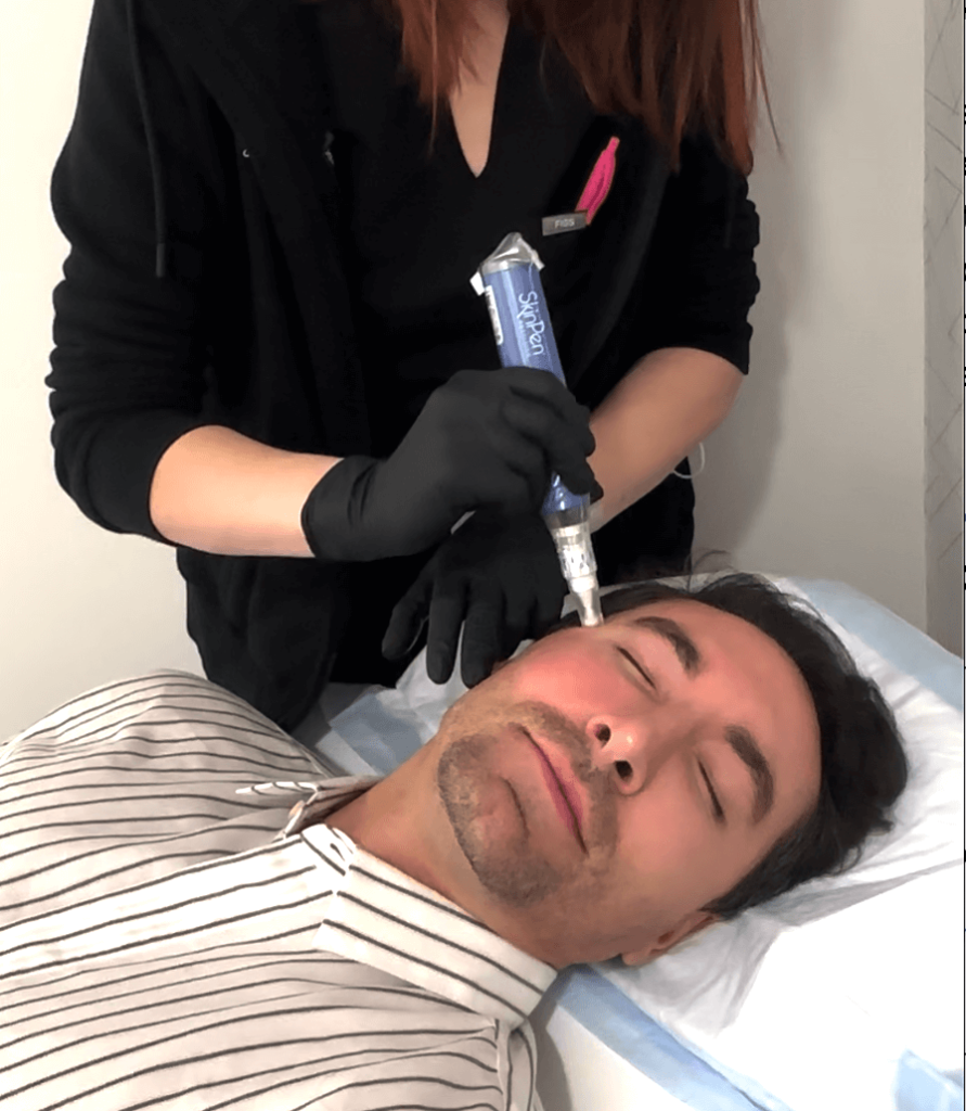 PRP facial procedure in progress, applying platelet-rich plasma to the face for skin revitalization in Cleveland. Bodytonic Medspa