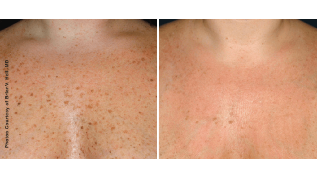 Before and After - Laser skin resurfacing decolletage