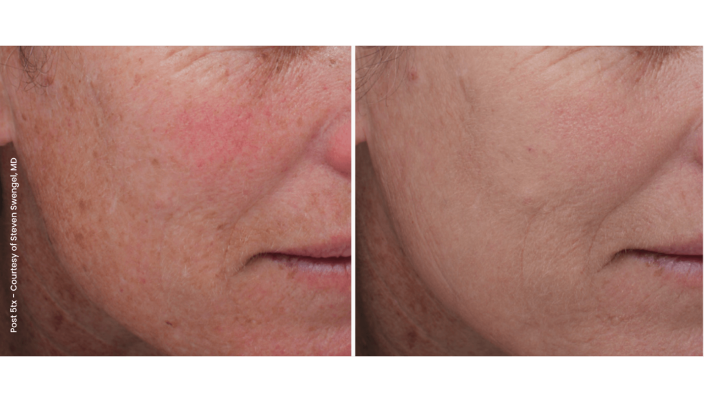 Before and after Post 5tx laser skin resurfacing