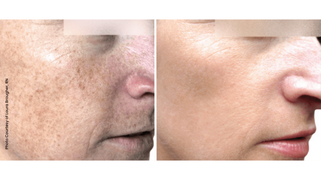 Before and After - Facial Laser Resurfacing