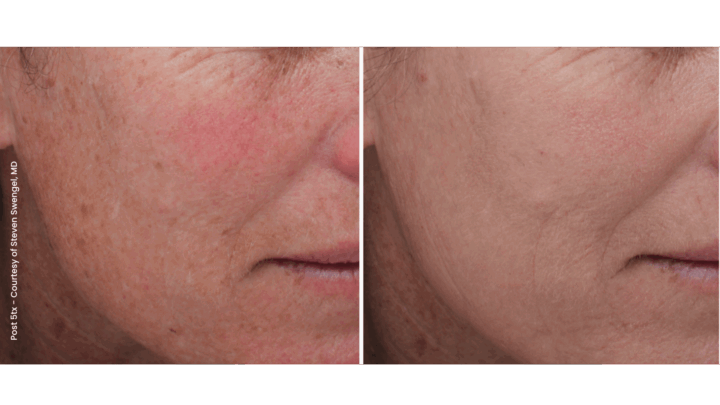 Moxi treatment in Cleveland. Before and after Post 5tx laser skin resurfacing