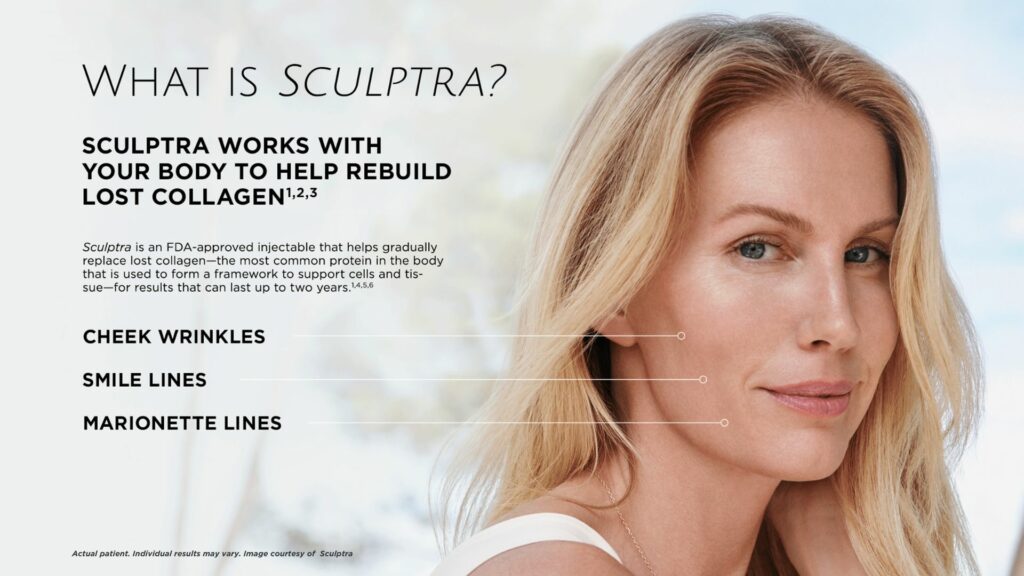 what is sculptra, sculpra fillers for cheek wrinkless, smile lines, marionette lines. BodyTonic medspa