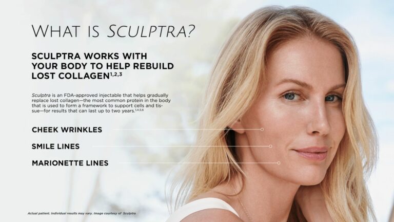 what is sculptra, sculpra fillers for cheek wrinkless, smile lines, marionette lines. BodyTonic medspa