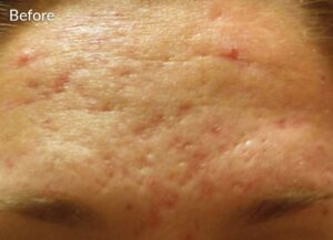 Acne scar - before treatment - skinpen Bodytonic Cleveland