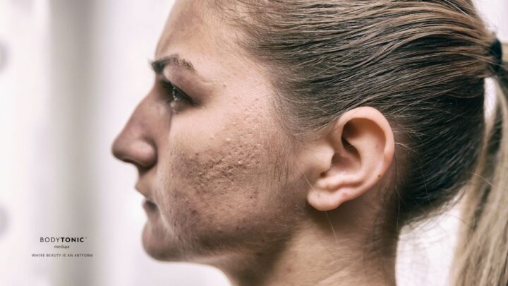 acne scarring, treatment, prevention and skincare at Bodytonic Cleveland