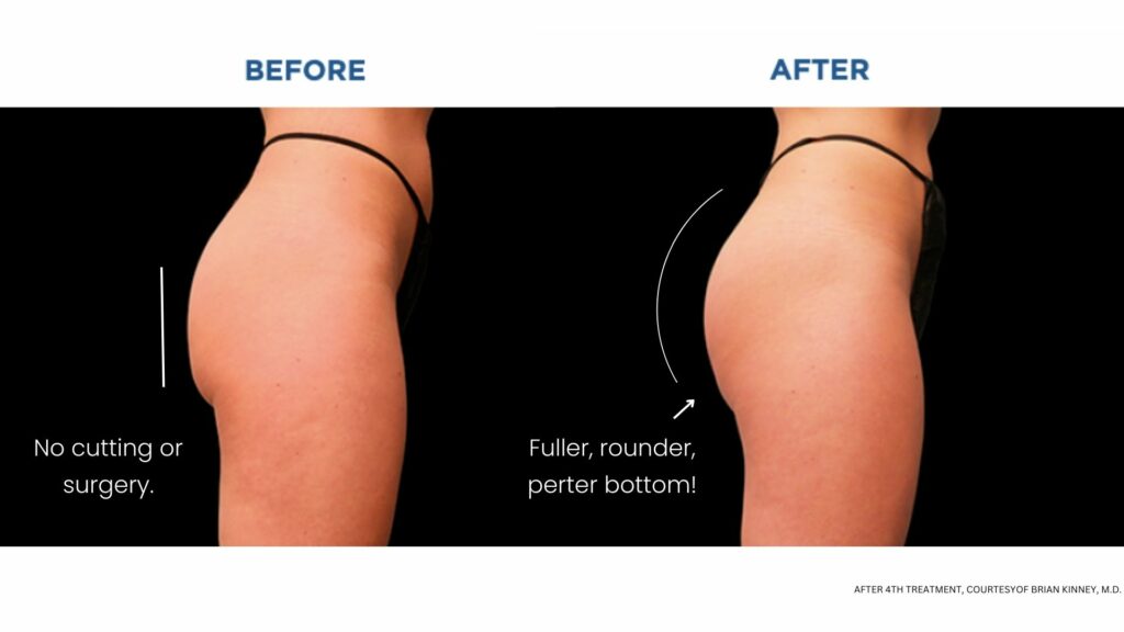 BodyTonic Non-Surgical Butt Lift in Cleveland - Free Consultation