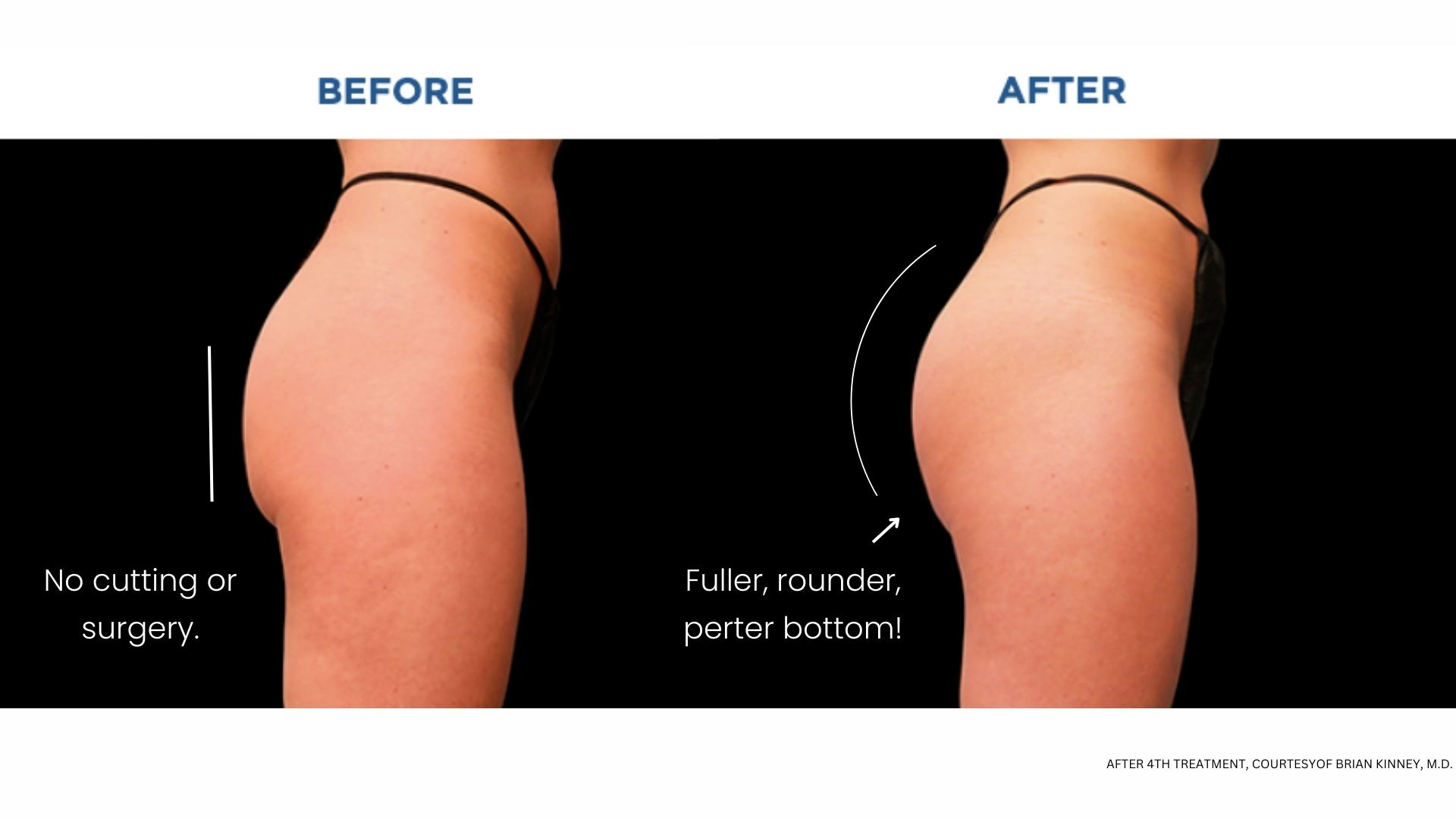 BodyTonic Non-Surgical Butt Lift in Cleveland - Free Consultation