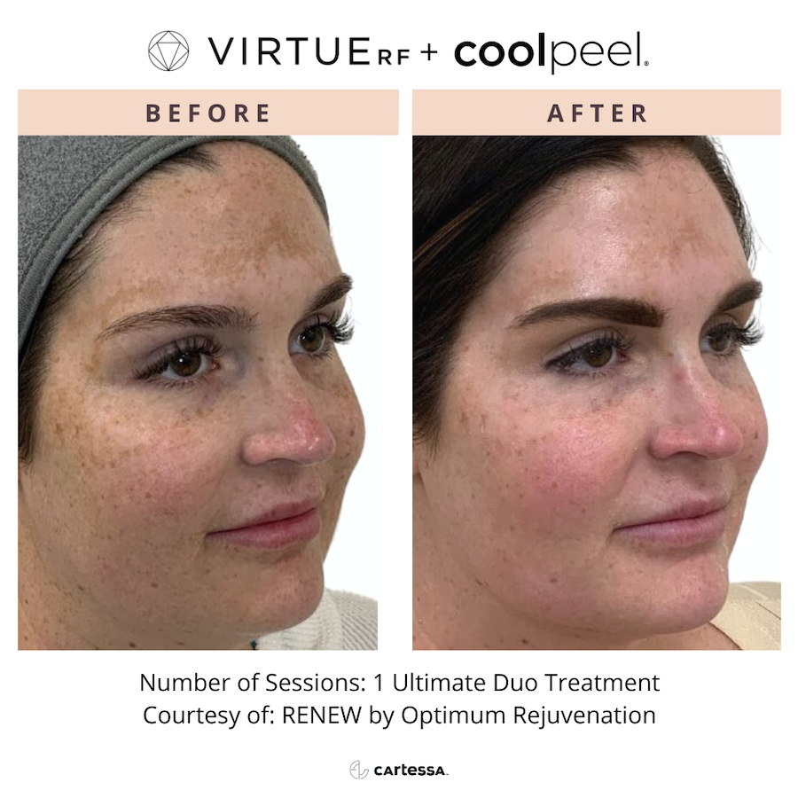 remove facial pigmentation with laser treatment Cleveland - Bodytonic