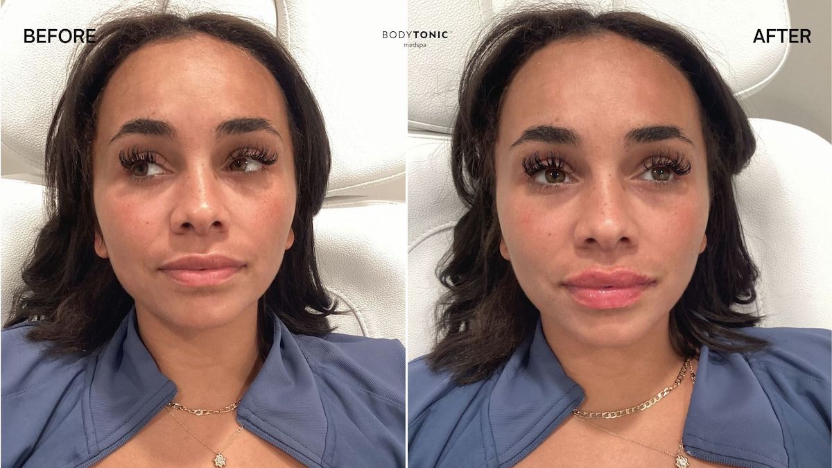 Dysport vs Botox - before and after using wrinkle relaxers. Bodytonic Cleveland