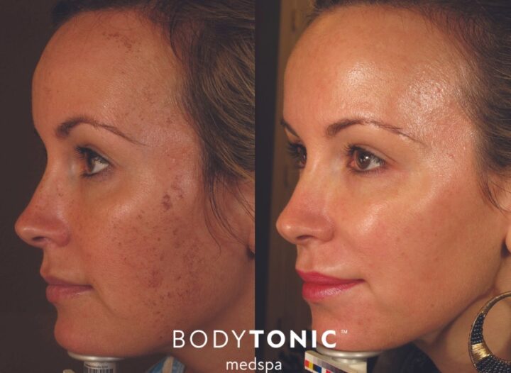 BBL laser facial before and after