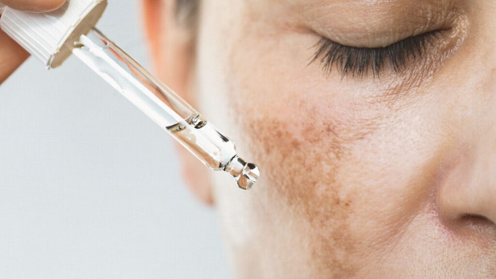 a person dripping a drop of medical sin care product into the face to help reducing post-inflammatory hyperpigmentation