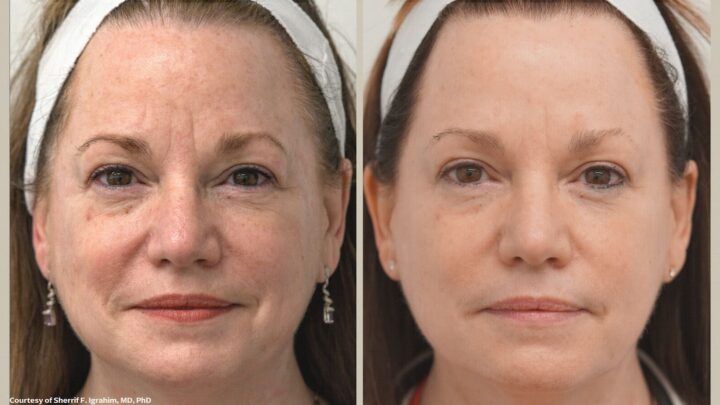 before and after having BBL hero laser treatment at BodyTonic Medspa Cleveland, Ohio