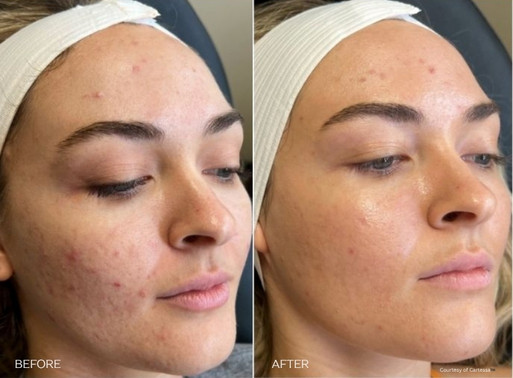 Coolpeel before and after
