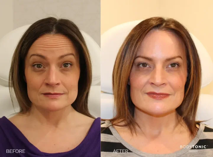 Before and after results of wrinkle relaxer treatment on the forehead at BodyTonic Medspa in Cleveland, highlighting smoother skin and reduced wrinkles.