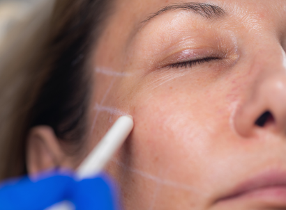 Close-up of a woman's face as a Medspa practitioner marks treatment areas with a pencil before wrinkle relaxer application at BodyTonic Medspa in Cleveland.